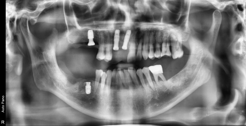Gigi goyang karena periodontitis di Cheonggu Station (pencabutan, implan) 사진 10