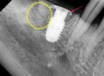 Gigi goyang karena periodontitis di Cheonggu Station (pencabutan, implan) 사진 9