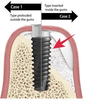 Gigi goyang karena periodontitis di Cheonggu Station (pencabutan, implan) 사진 7