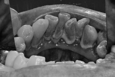 Gigi goyang karena periodontitis di Cheonggu Station (pencabutan, implan) 사진 3