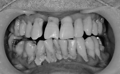 Gigi goyang karena periodontitis di Cheonggu Station (pencabutan, implan)