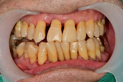 Gigi goyang karena periodontitis di Cheonggu Station (pencabutan, implan) 사진 4