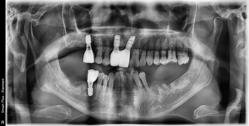 Gigi goyang karena periodontitis di Cheonggu Station (pencabutan, implan) 사진 11