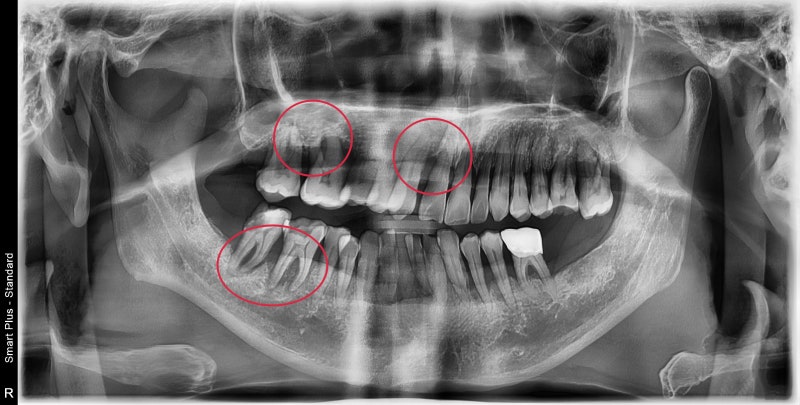 Gigi goyang karena periodontitis di Cheonggu Station (pencabutan, implan)