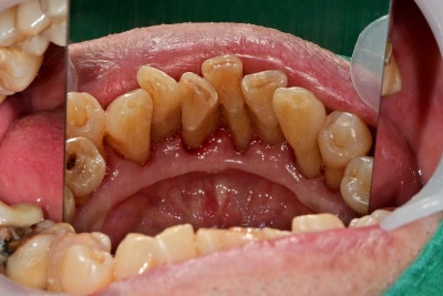 Gigi goyang karena periodontitis di Cheonggu Station (pencabutan, implan) 사진 5