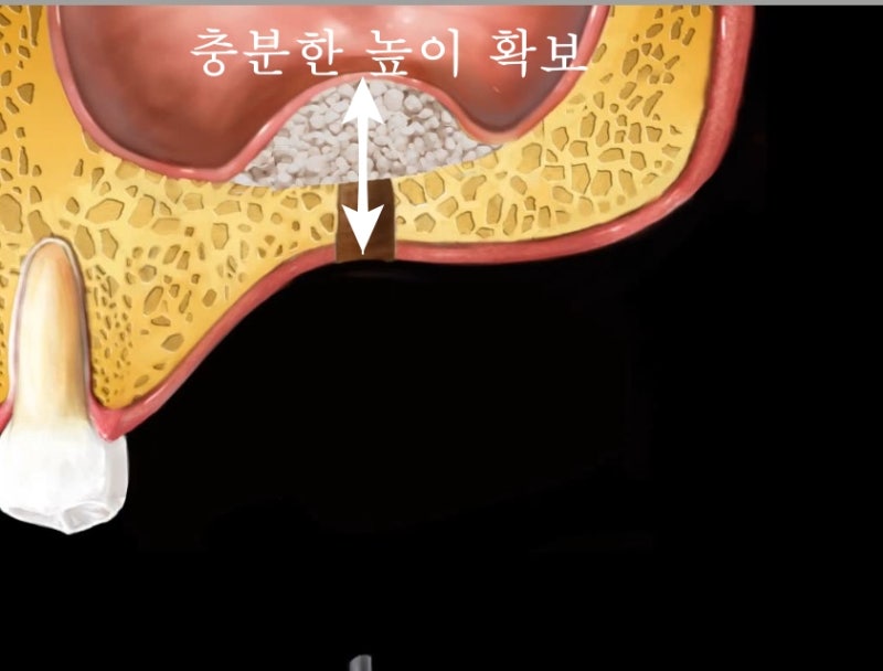 Implan Gigi di Sindang-dong: Operasi Implan (Sinus Lift) pada Gigi yang Hilang Lama 사진 4
