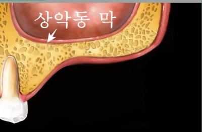 Implan Gigi di Sindang-dong: Operasi Implan (Sinus Lift) pada Gigi yang Hilang Lama 사진 2