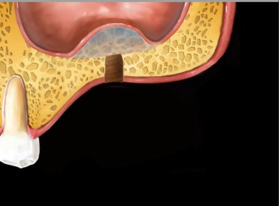 Implan Gigi di Sindang-dong: Operasi Implan (Sinus Lift) pada Gigi yang Hilang Lama 사진 3
