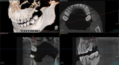 Implan Gigi di Sindang-dong: Operasi Implan (Sinus Lift) pada Gigi yang Hilang Lama 사진 8