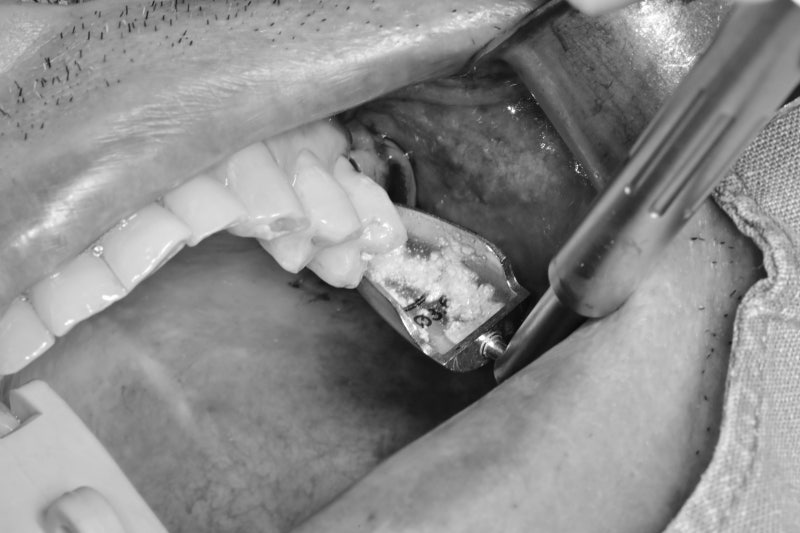 Implan Gigi di Sindang-dong: Operasi Implan (Sinus Lift) pada Gigi yang Hilang Lama 사진 7