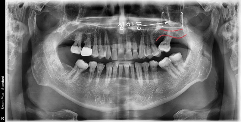 Implan Gigi di Sindang-dong: Operasi Implan (Sinus Lift) pada Gigi yang Hilang Lama