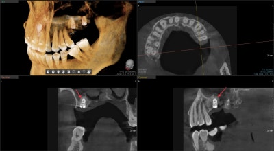 Implan Gigi di Sindang-dong: Operasi Implan (Sinus Lift) pada Gigi yang Hilang Lama