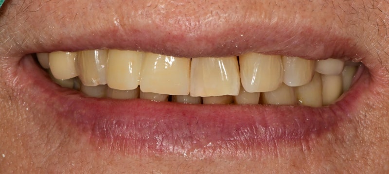 Yaksu-dong Dental Clinic: Treating Receding Gums Without Tooth Reduction 사진 9