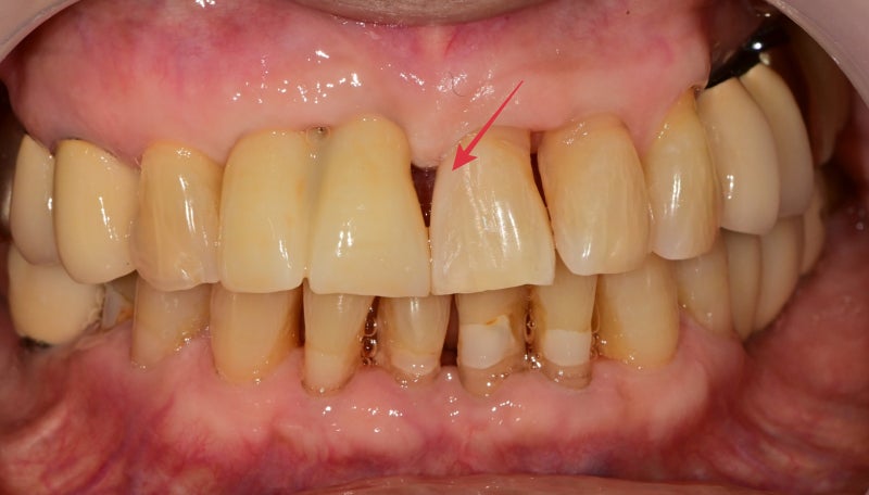 Yaksu-dong Dental Clinic: Treating Receding Gums Without Tooth Reduction