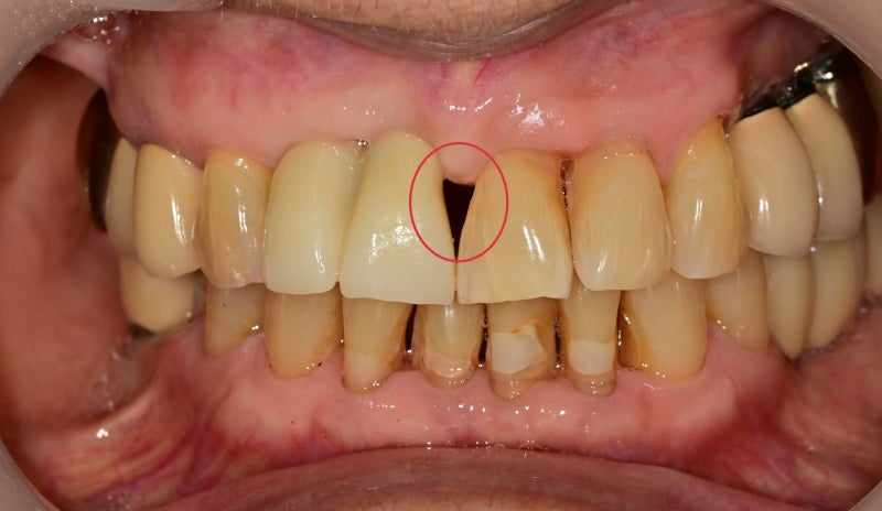Yaksu-dong Dental Clinic: Treating Receding Gums Without Tooth Reduction 사진 6