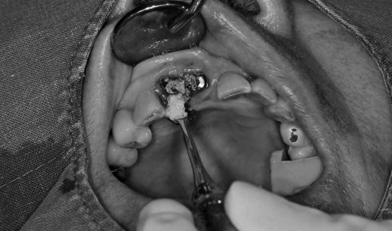 Yaksu-dong Dental Clinic: Treating Receding Gums Without Tooth Reduction 사진 5