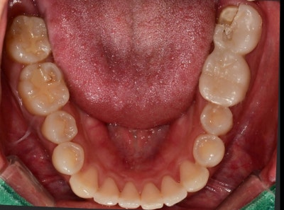 Dongdae Entrance Station Dental Clinic: When a Bruxism Appliance is Needed (TMJ Pain) 사진 2