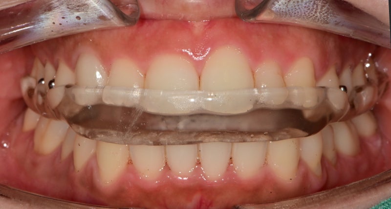 Dongdae Entrance Station Dental Clinic: When a Bruxism Appliance is Needed (TMJ Pain)