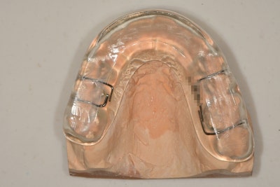 Dongdae Entrance Station Dental Clinic: When a Bruxism Appliance is Needed (TMJ Pain) 사진 4