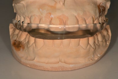 Dongdae Entrance Station Dental Clinic: When a Bruxism Appliance is Needed (TMJ Pain) 사진 3