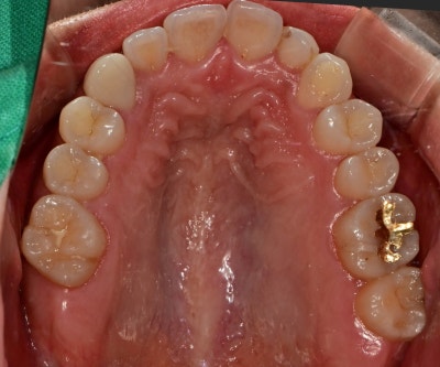 Dongdae Entrance Station Dental Clinic: When a Bruxism Appliance is Needed (TMJ Pain)