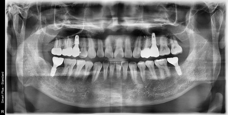 Jangchung-dong Area Dental Clinic: Treatment Methods for Old Cavities and Missing Teeth 사진 6