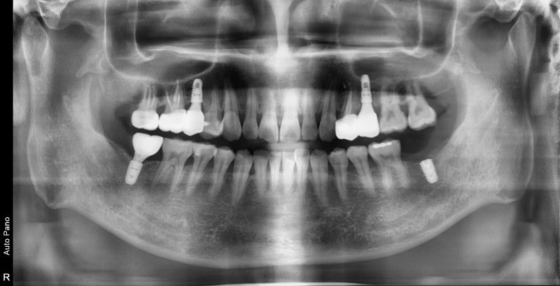 Jangchung-dong Area Dental Clinic: Treatment Methods for Old Cavities and Missing Teeth 사진 5