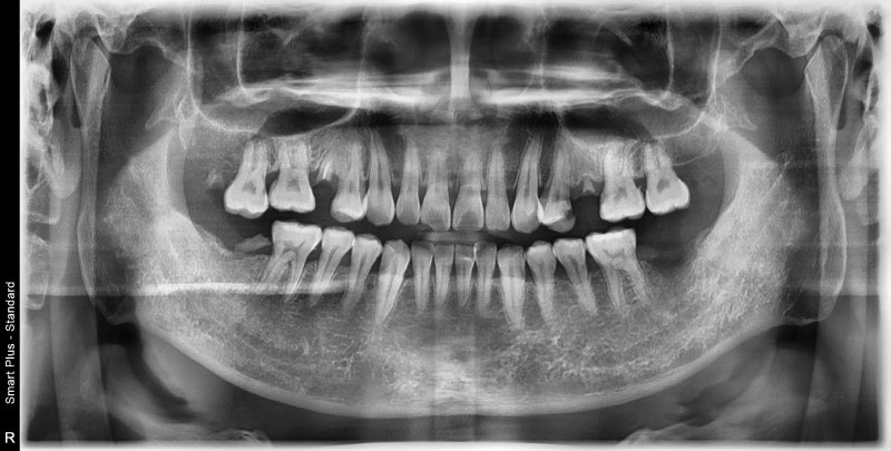 Jangchung-dong Area Dental Clinic: Treatment Methods for Old Cavities and Missing Teeth