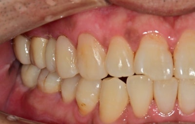 Jangchung-dong Area Dental Clinic: Treatment Methods for Old Cavities and Missing Teeth 사진 7