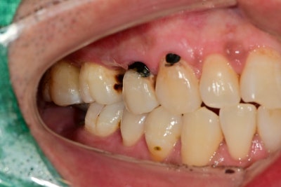 Jangchung-dong Area Dental Clinic: Treatment Methods for Old Cavities and Missing Teeth 사진 2