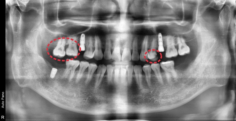 Jangchung-dong Area Dental Clinic: Treatment Methods for Old Cavities and Missing Teeth