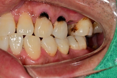 Jangchung-dong Area Dental Clinic: Treatment Methods for Old Cavities and Missing Teeth 사진 3