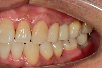 Jangchung-dong Area Dental Clinic: Treatment Methods for Old Cavities and Missing Teeth 사진 8