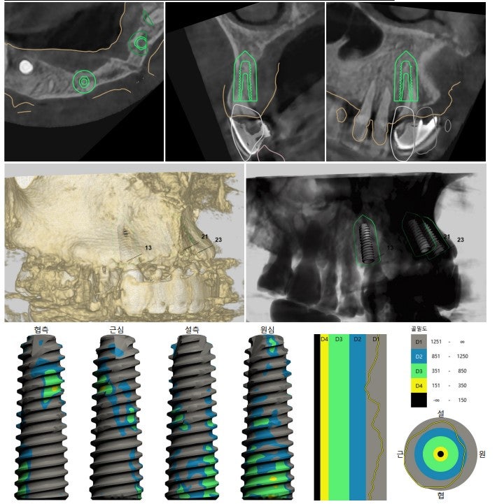 Hannam-dong Dental Clinic: Guided Implant Surgery (Flapless Surgery) Using an Intraoral Scanner 사진 3