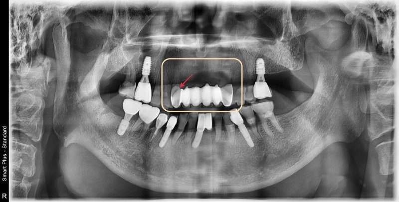 Hannam-dong Dental Clinic: Guided Implant Surgery (Flapless Surgery) Using an Intraoral Scanner