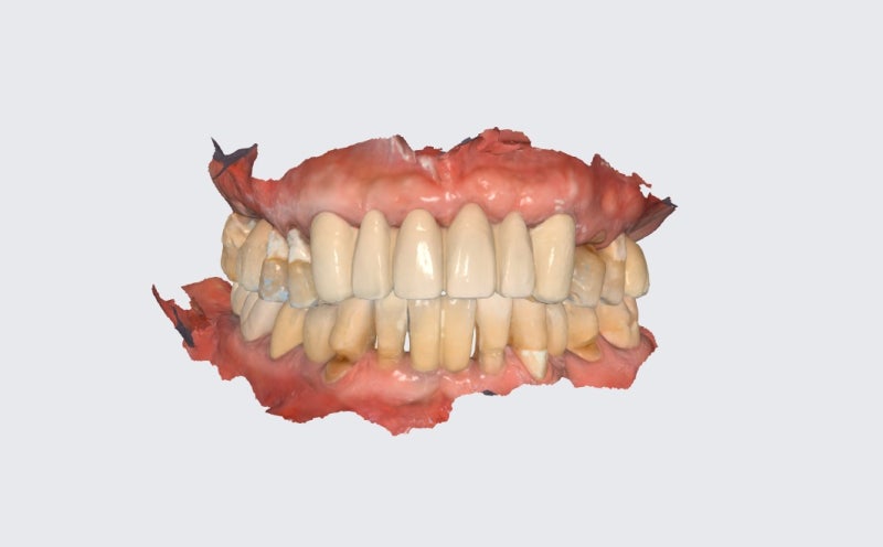 Hannam-dong Dental Clinic: Guided Implant Surgery (Flapless Surgery) Using an Intraoral Scanner 사진 2