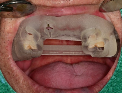 Hannam-dong Dental Clinic: Guided Implant Surgery (Flapless Surgery) Using an Intraoral Scanner 사진 5
