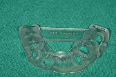 Hannam-dong Dental Clinic: Guided Implant Surgery (Flapless Surgery) Using an Intraoral Scanner 사진 4