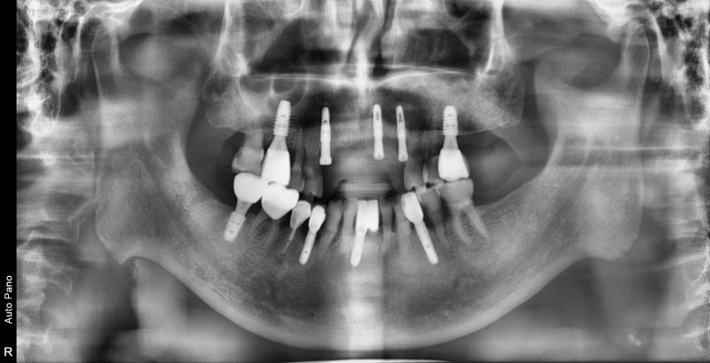 Hannam-dong Dental Clinic: Guided Implant Surgery (Flapless Surgery) Using an Intraoral Scanner