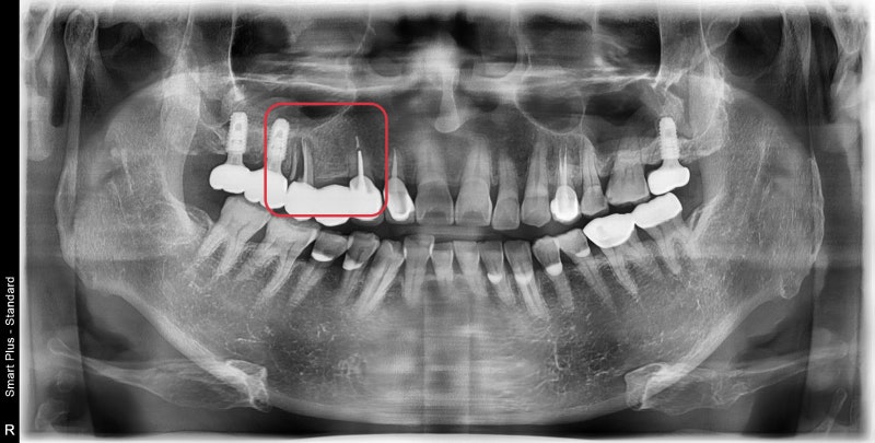 Why You Shouldn't Neglect Inflammation Around Root Canal-Treated Teeth (Extraction and Implant) at Geumho-dong Dental Cl