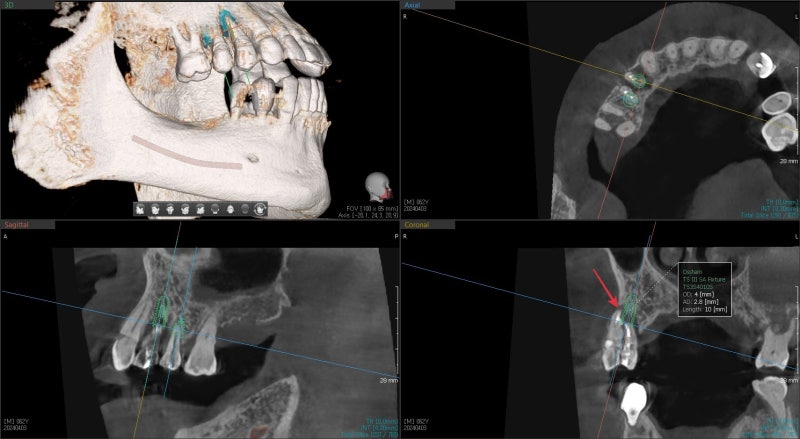 Why You Shouldn't Neglect Inflammation Around Root Canal-Treated Teeth (Extraction and Implant) at Geumho-dong Dental Cl