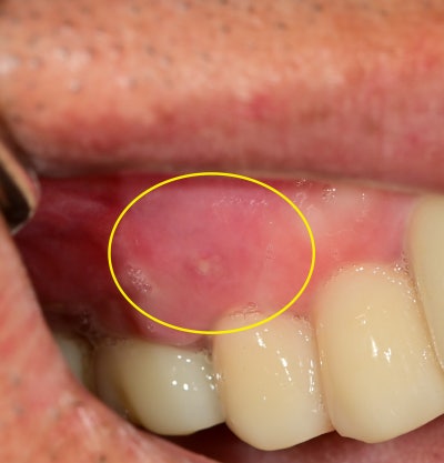 Why You Shouldn't Neglect Inflammation Around Root Canal-Treated Teeth (Extraction and Implant) at Geumho-dong Dental Cl