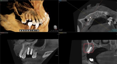 Why You Shouldn't Neglect Inflammation Around Root Canal-Treated Teeth (Extraction and Implant) at Geumho-dong Dental Clinic