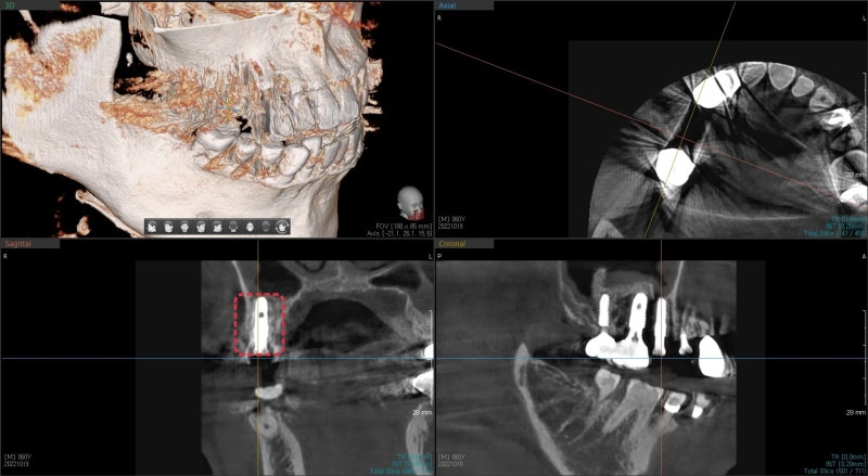 Why You Shouldn't Neglect Inflammation Around Root Canal-Treated Teeth (Extraction and Implant) at Geumho-dong Dental Cl