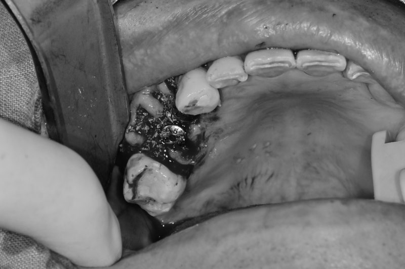 Why You Shouldn't Neglect Inflammation Around Root Canal-Treated Teeth (Extraction and Implant) at Geumho-dong Dental Cl