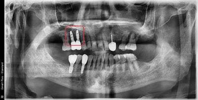 Why You Shouldn't Neglect Inflammation Around Root Canal-Treated Teeth (Extraction and Implant) at Geumho-dong Dental Cl