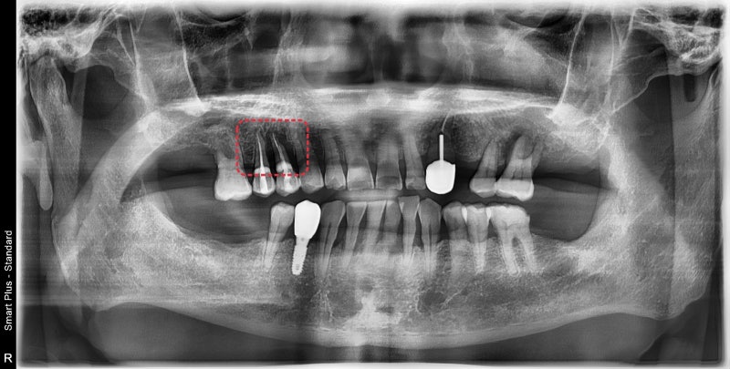 Why You Shouldn't Neglect Inflammation Around Root Canal-Treated Teeth (Extraction and Implant) at Geumho-dong Dental Cl