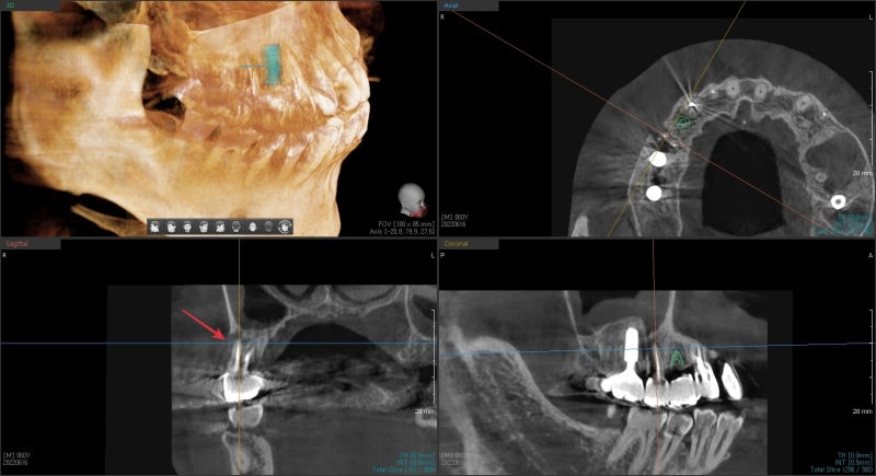 Why You Shouldn't Neglect Inflammation Around Root Canal-Treated Teeth (Extraction and Implant) at Geumho-dong Dental Cl