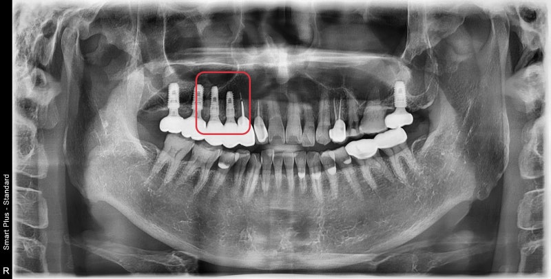 Why You Shouldn't Neglect Inflammation Around Root Canal-Treated Teeth (Extraction and Implant) at Geumho-dong Dental Cl