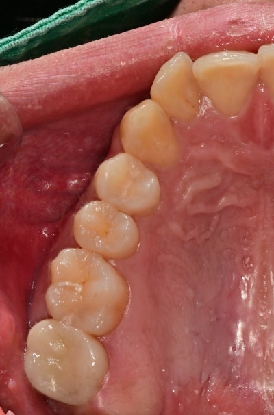 Стоматологическое лечение в Сеуле, район Чунгу: Нужна ли коронка после лечения корневых каналов? 사진 4